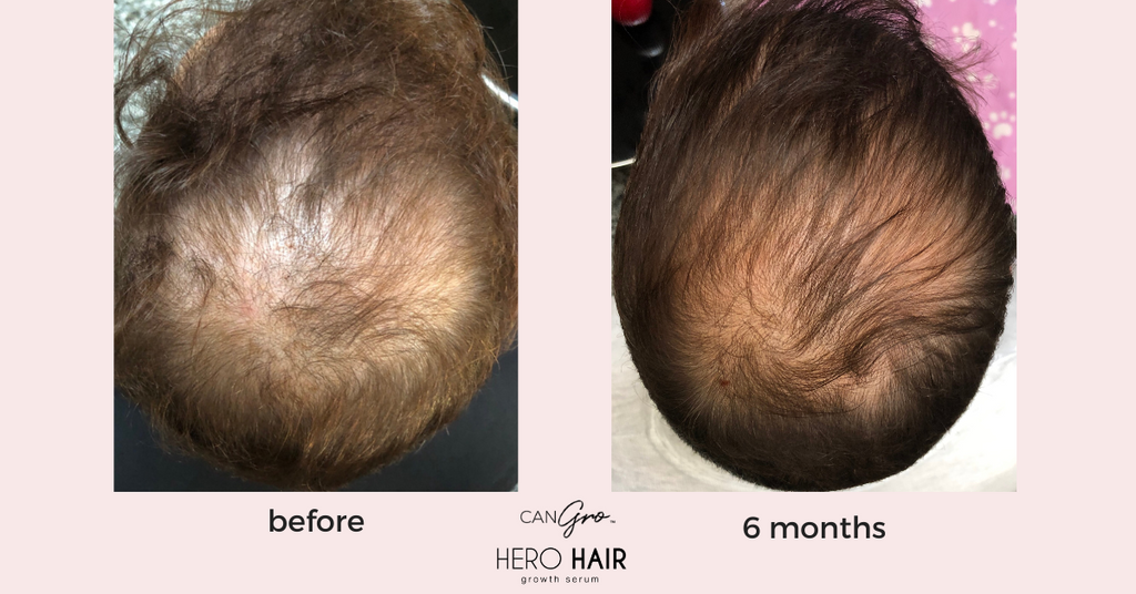 Advanced Hair Growth Serum - CanGro